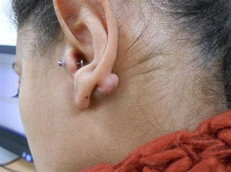 Keloids and Piercing: The Relationship between the Two