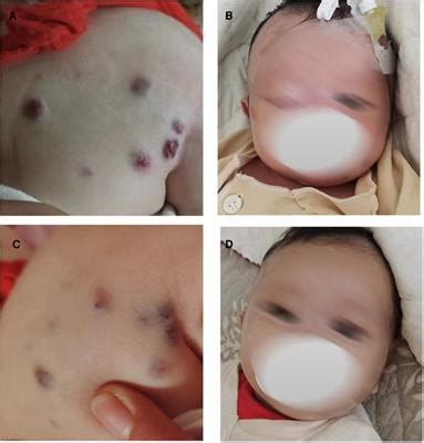 Frontiers | Case report: Blue rubber bleb nevus syndrome with Kasabach-Merritt phenomenon in a ...