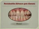 PPT - Causes Of Periodontal Gum Disease PowerPoint Presentation, free download - ID:11423478
