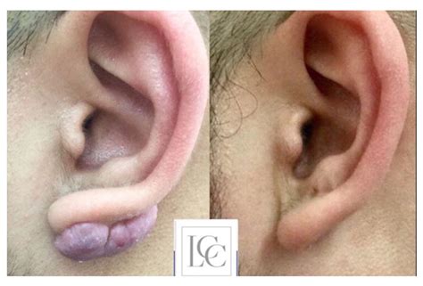 Keloid On-Ear: Causes and Treatments | Keloid Scar Treatment Clinic | Keloid Scar Treatment Clinic