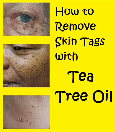 Gentle and Natural Skin Tag Removal with Tea Tree Oil