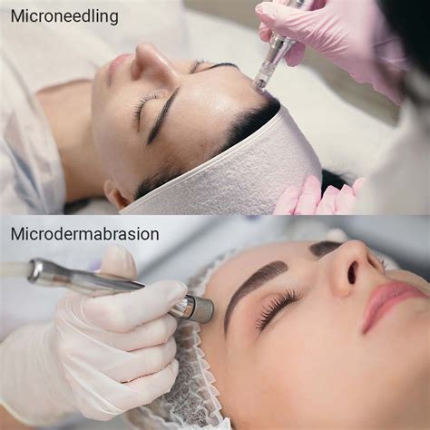 Microdermabrasion VS Microneedling - Honest Comparison