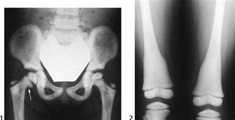 116 Osteopetrosis | Radiology Key