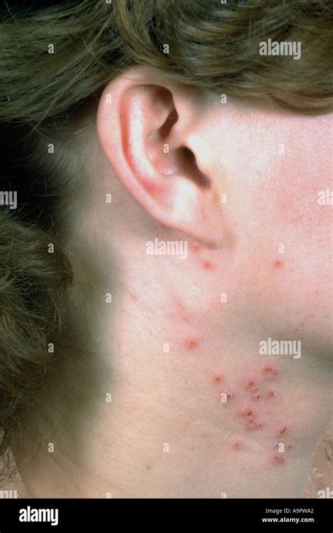 Herpes zoster rash blisters hi-res stock photography and images - Alamy