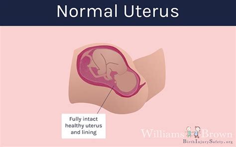 Medical Negligence Leading to Uterine Rupture and Birth Injury - Brown Trial Firm