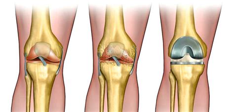 Arthritis and Bone Spurs | Athletic Orthopedics & Knee Center | Sports ...