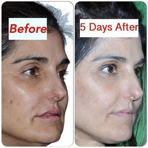 Vampire Facelift Before And After Photos (2) » Facelift: Info, Prices, Photos, Reviews, Q&A