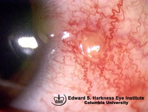 Phlyctenular Keratoconjunctivitis | Vagelos College of Physicians and Surgeons