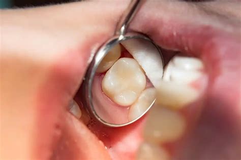 Broken Tooth Filling: When to Go In & What’s Next?