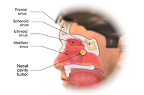 Maxillary Sinus Cancer