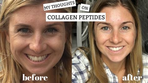 What Are The Benefits Of Collagen Hydrolysate