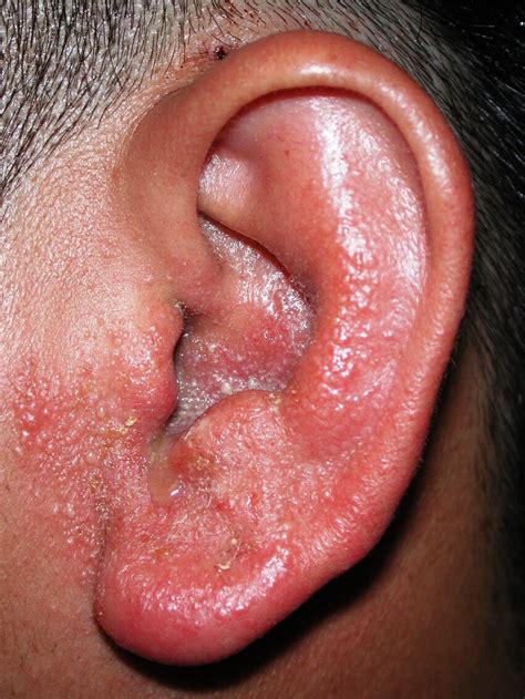 (PDF) Allergic Contact Dermatitis of the Auricle