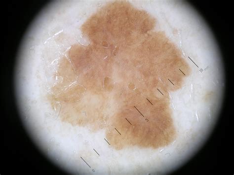 Large cell acanthoma