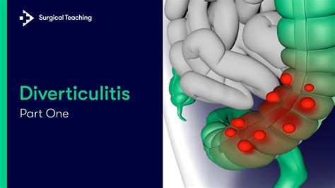 Diverticulitis Part 1 | What is it and What Causes it? - YouTube