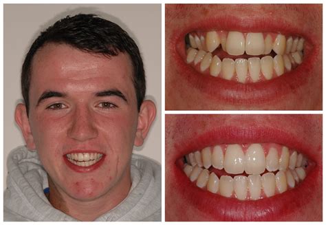 Teeth Before And After Braces Crowding