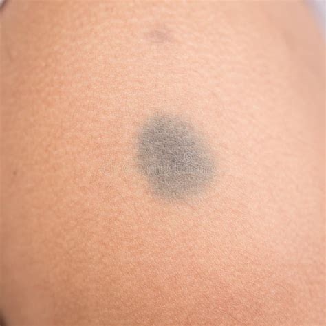 Birthmark On Skin Stock Photo - Image: 51469816