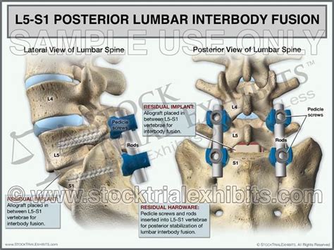 L5-S1 Posterior Lumbar Interbody Fusion (PLIF) - Detailed Trial Exhibit Board