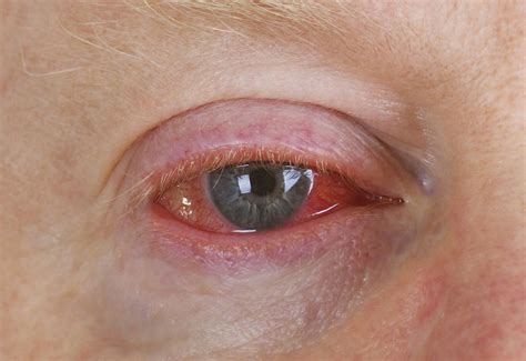 Bacterial conjunctivitis treatment with home remedies - Health Care ...