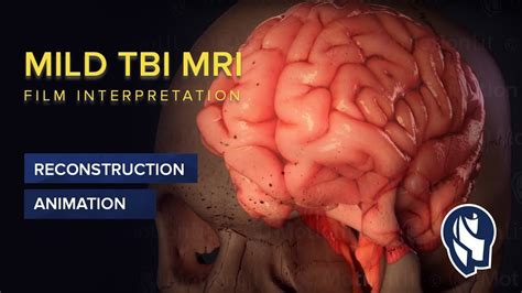 Mild TBI MRI Film Interpretation - 3D Animation - YouTube