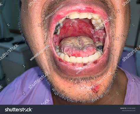 Severe Mucosal Ulcer Patient Sore ThroatẢnh có sẵn1674413428 | Shutterstock