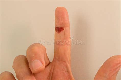 Blood Blister on a Man’s Index Finger Stock Image - Image of injury, hurt: 193229101