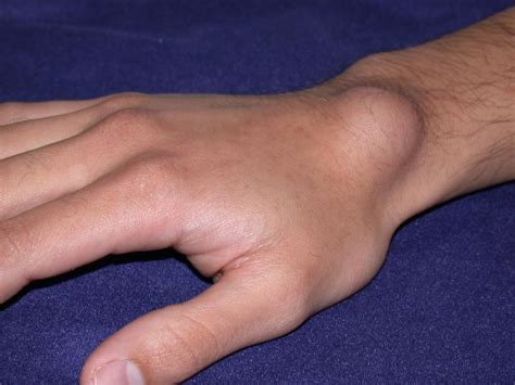 Ganglion cyst of hand and wrist treatment by Raleigh Hand Center | Raleigh Hand to Shoulder Center