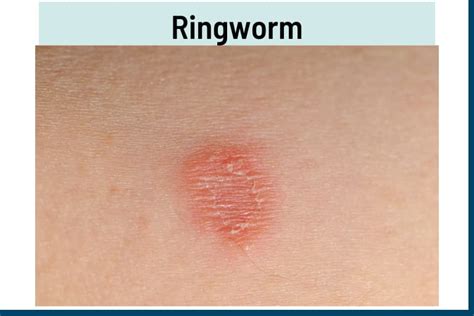 Skin Rashes That Look Like Ringworm - vrogue.co