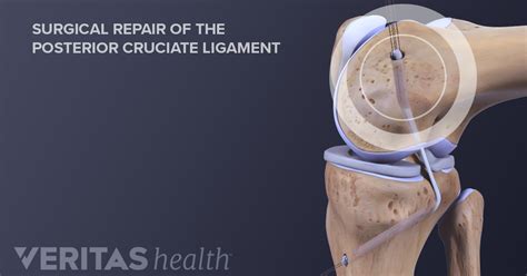 Posterior Cruciate Ligament (PCL) Tear Treatment Options