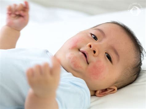 Infant Rashes – Causes & Treatment