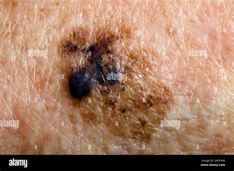 Superficial Spreading Malignant Melanoma