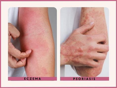 Psoriasis vs. Eczema: How to Tell Them Apart - Remotederm