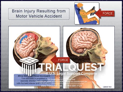 Brain Injury Resulting from Motor Vehicle Accident - TrialExhibits Inc.