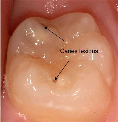 Caries lesions on the occlusal surface of molar tooth | Download Scientific Diagram