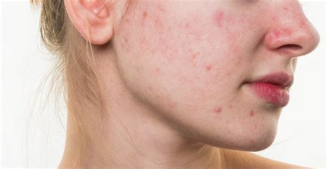 Acne Rosacea Treatment - Dermatology Consultants of South Florida