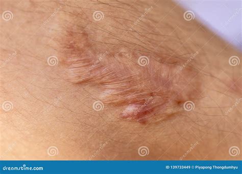 A Scar Is An Area Of Fibrous Tissue That Replaces Normal Skin. Royalty ...