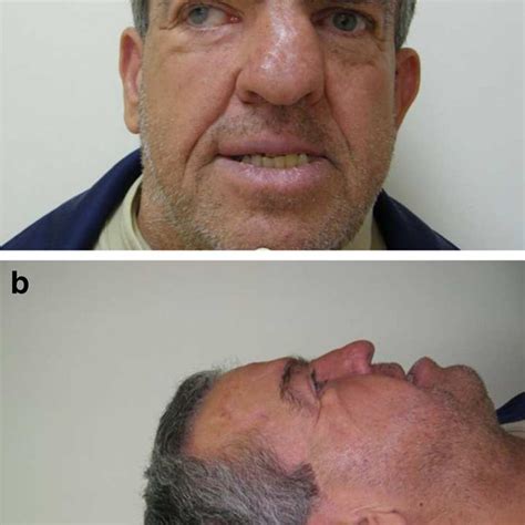 Frontal view of the son of the patient. Frontal bossing, broad nasal... | Download Scientific ...