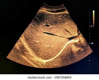 Ultrasound Liver Ultrasound Image Healthy Hepar Stock Photo 1987296893 ...