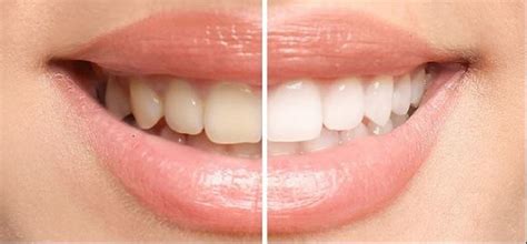 How to Whiten Teeth in Photoshop Elements