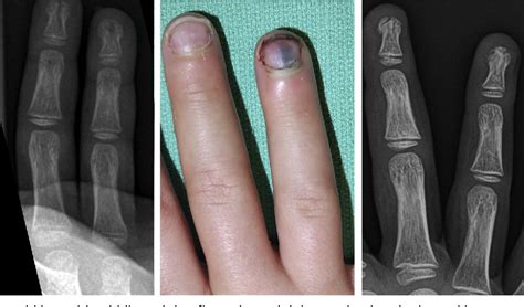 Figure 2 from Pediatric hand fractures. | Semantic Scholar