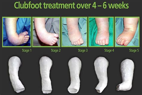 Club Foot - Congenital Clubfoot Causes, Types, Symptoms & Treatment