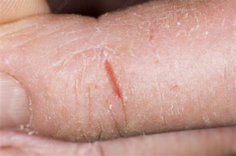 Cracked skin on finger in eczema - Stock Image - C009/0046 - Science ...