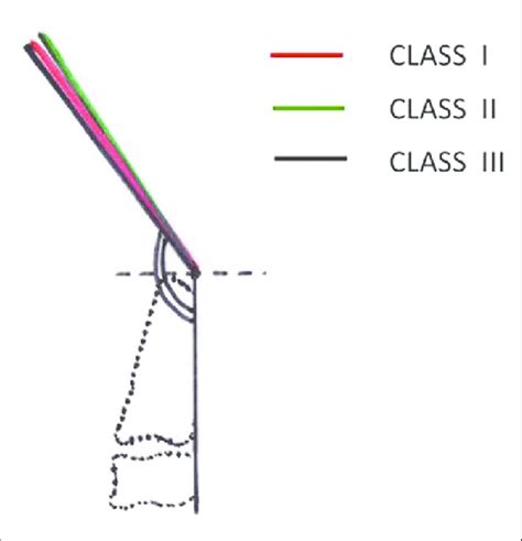 Minimum observed clivo‑axial angle for Class I, II, and III were 145°,... | Download Scientific ...