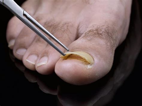 Toenail falling off ICD 10 Code - Podiatry Coding