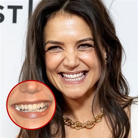 21 Celebrity Dental Implants And Veneers: Before And After