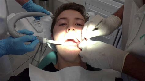 wisdom tooth pulled - YouTube