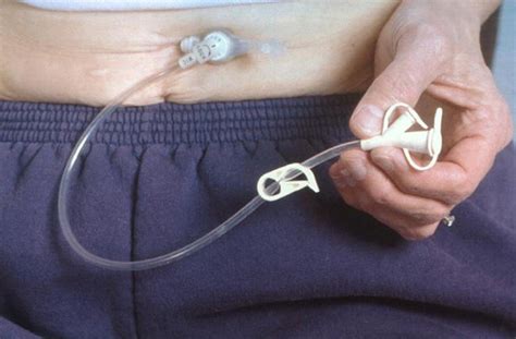 Percutaneous endoscopic gastrostomy (PEG): a practical approach for long term management | The BMJ