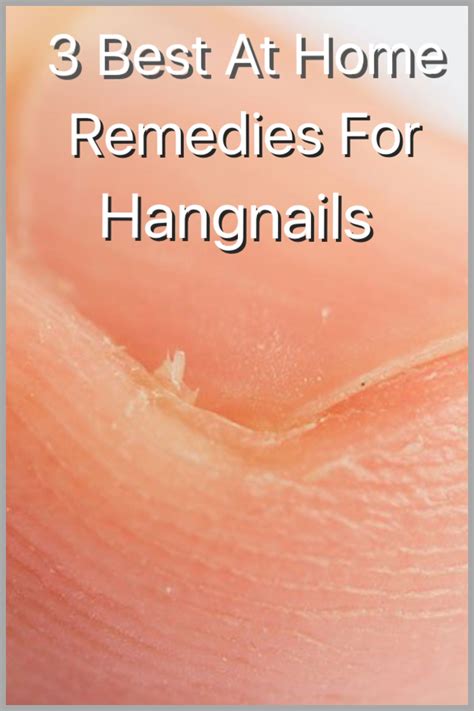 How To Get Rid Of Hangnail Infection