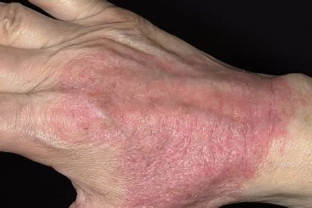 Atopic Dermatitis In Adults And Children - Causes, Symptoms, Diet And Treatment Of Atopic ...