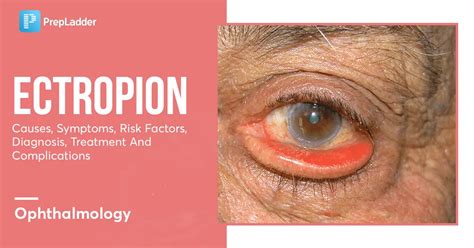 Ectropion: Causes, Symptoms, Risk Factors, Diagnosis, Treatment and Complications