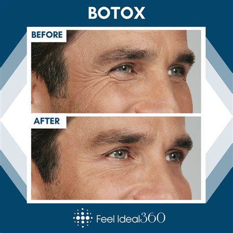 Botox Before And After Man Wrinkles - Feel Ideal 360 Med Spa ...